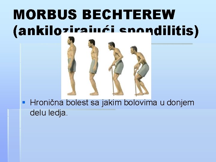MORBUS BECHTEREW (ankilozirajući spondilitis) § Hronična bolest sa jakim bolovima u donjem delu ledja.