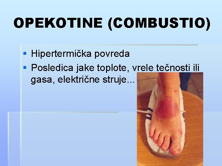 OPEKOTINE (COMBUSTIO) § Hipertermička povreda § Posledica jake toplote, vrele tečnosti ili gasa, električne