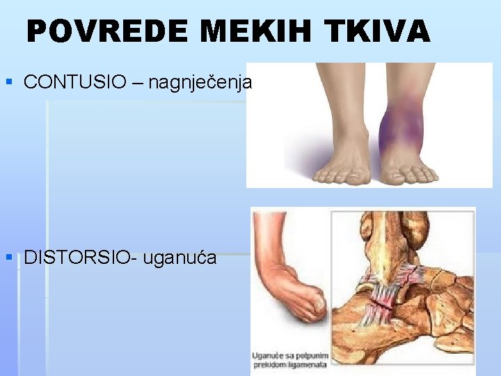 POVREDE MEKIH TKIVA § CONTUSIO – nagnječenja § DISTORSIO- uganuća 