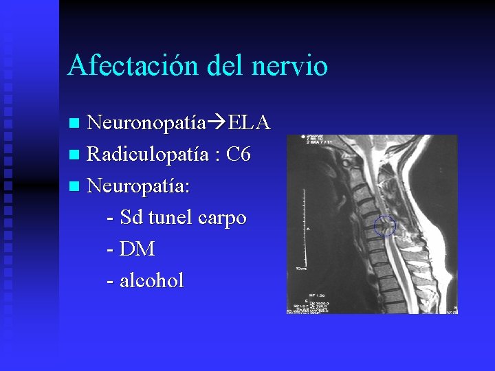 Afectación del nervio Neuronopatía ELA n Radiculopatía : C 6 n Neuropatía: - Sd