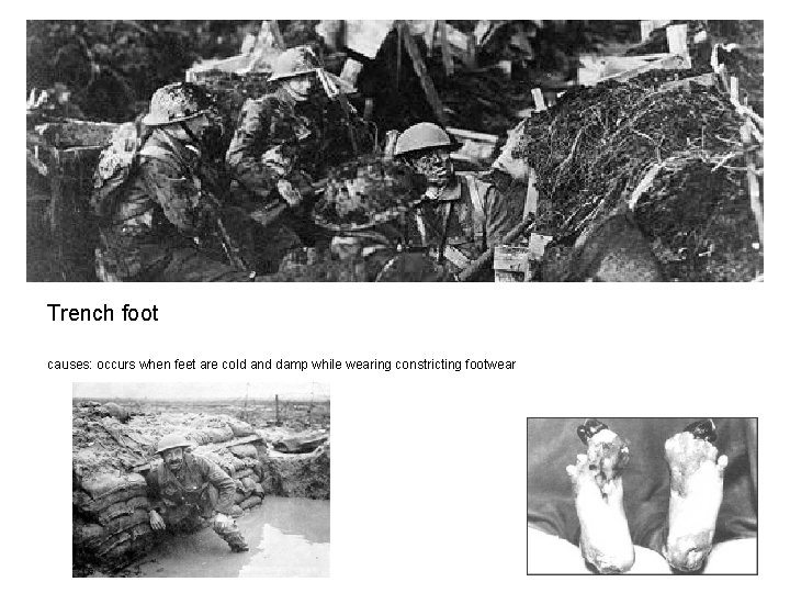 Trench foot causes: occurs when feet are cold and damp while wearing constricting footwear