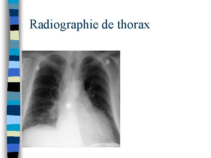 Radiographie de thorax 