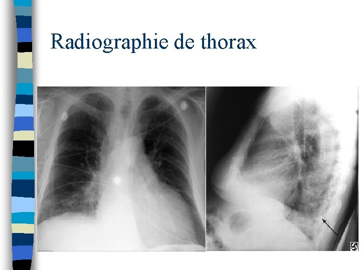 Radiographie de thorax 