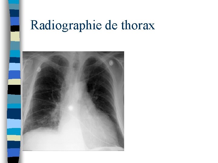 Radiographie de thorax 