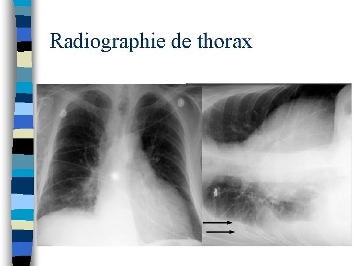 Radiographie de thorax 