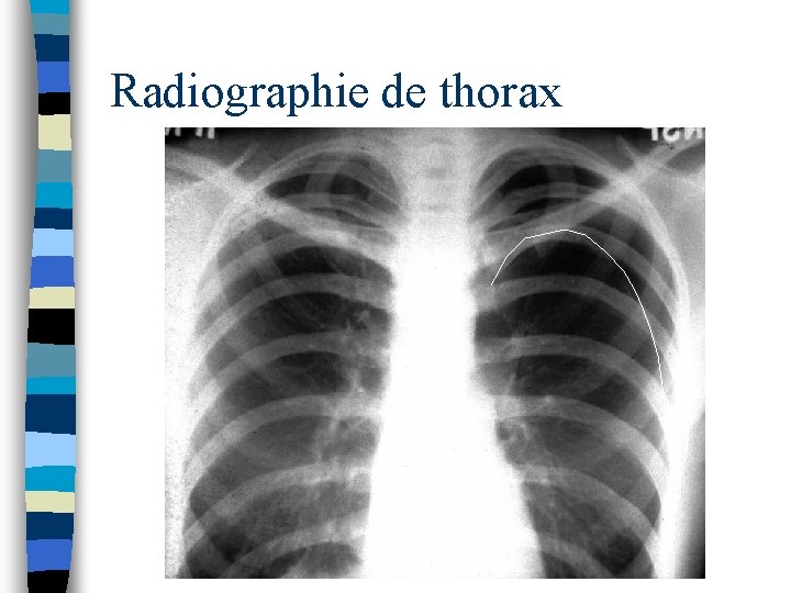 Radiographie de thorax 