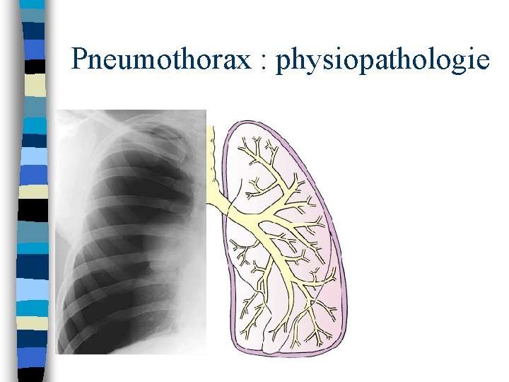 Pneumothorax : physiopathologie 