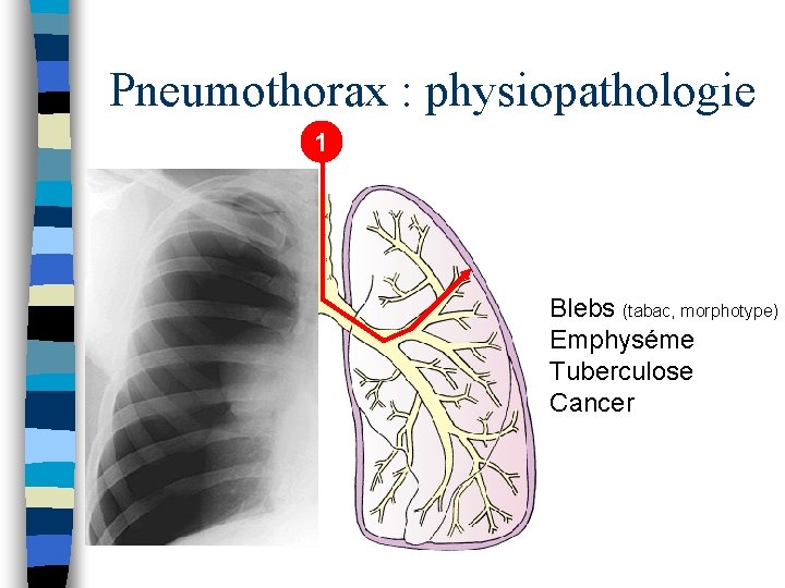 Pneumothorax : physiopathologie 1 Blebs (tabac, morphotype) Emphyséme Tuberculose Cancer 