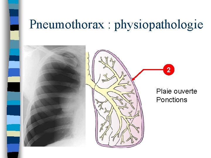 Pneumothorax : physiopathologie 2 Plaie ouverte Ponctions 