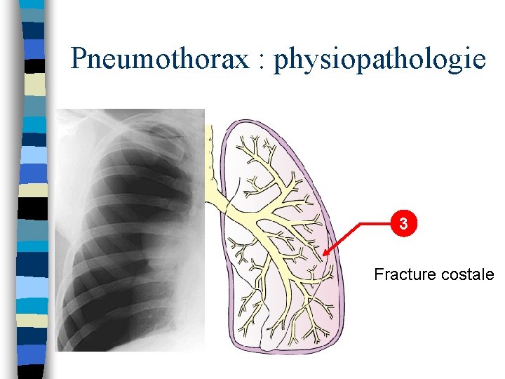 Pneumothorax : physiopathologie 3 Fracture costale 