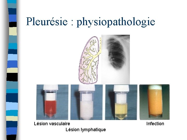 Pleurésie : physiopathologie Lésion vasculaire Lésion lymphatique Infection 