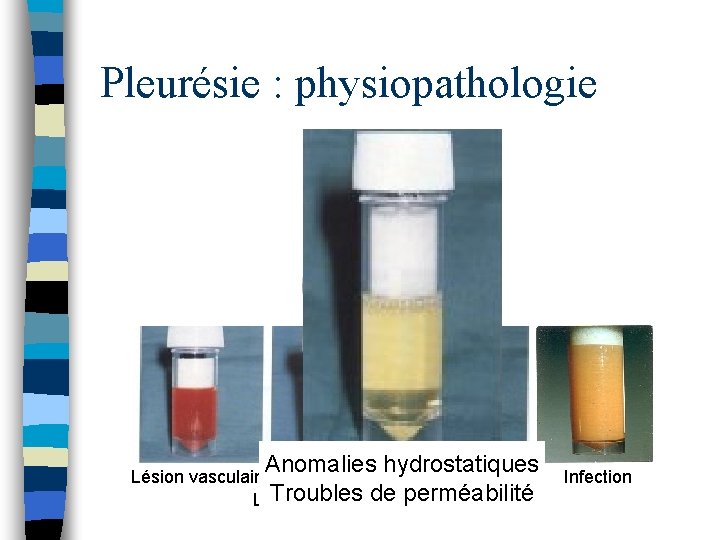 Pleurésie : physiopathologie Anomalies hydrostatiques Lésion vasculaire Troubles de perméabilité Lésion lymphatique Infection 