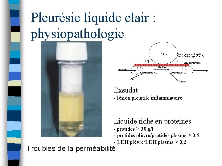Pleurésie liquide clair : physiopathologie Exsudat - lésion pleurale inflammatoire Liquide riche en protéines