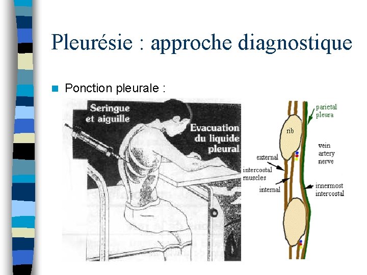 Pleurésie : approche diagnostique n Ponction pleurale : 