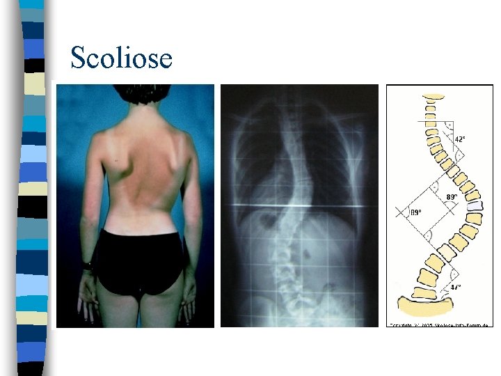 Scoliose 