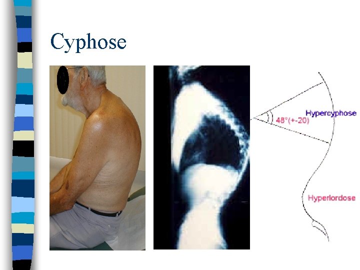 Cyphose 
