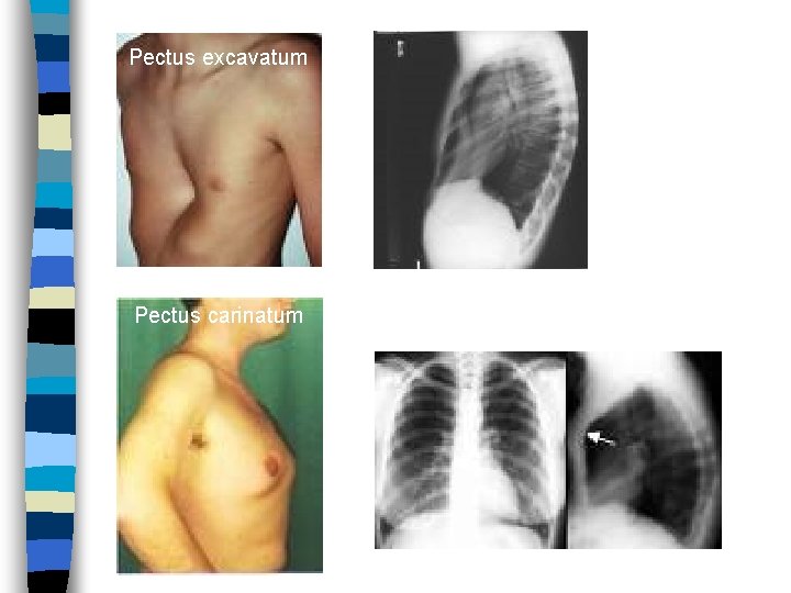Pectus excavatum Pectus carinatum 