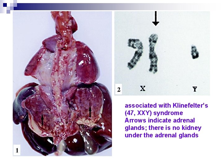 associated with Klinefelter’s (47, XXY) syndrome Arrows indicate adrenal glands; there is no kidney