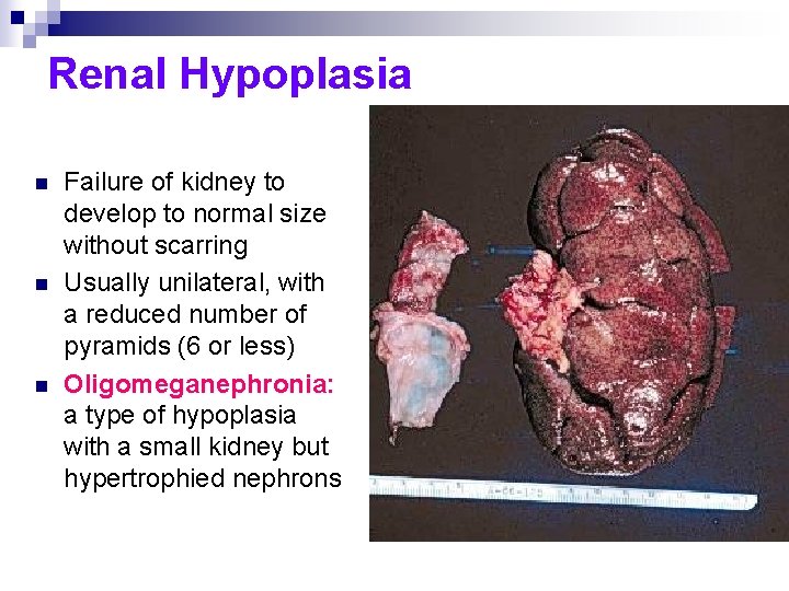 Renal Hypoplasia n n n Failure of kidney to develop to normal size without