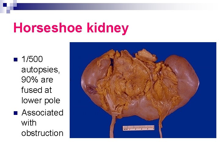 Horseshoe kidney n n 1/500 autopsies, 90% are fused at lower pole Associated with