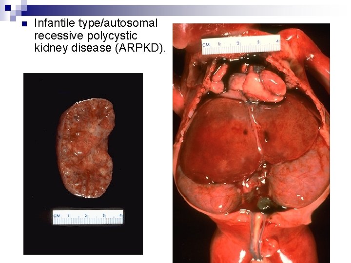 n Infantile type/autosomal recessive polycystic kidney disease (ARPKD). 