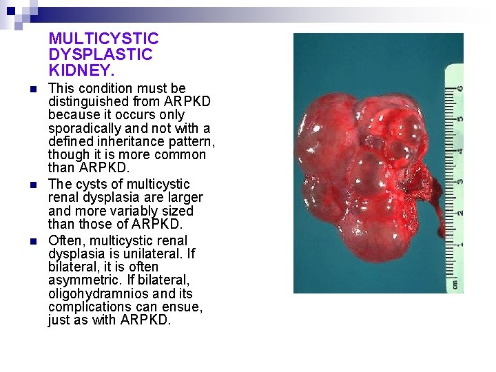 MULTICYSTIC DYSPLASTIC KIDNEY. n n n This condition must be distinguished from ARPKD because