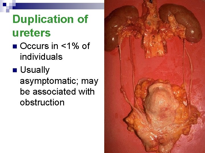 Duplication of ureters Occurs in <1% of individuals n Usually asymptomatic; may be associated