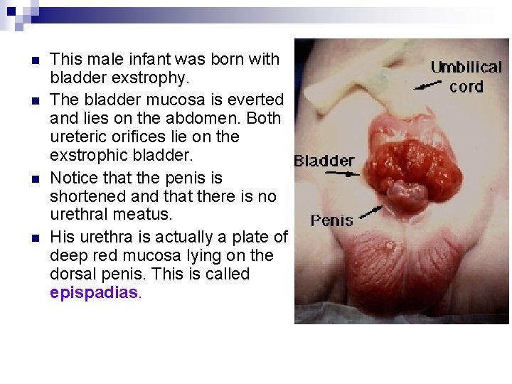 n n This male infant was born with bladder exstrophy. The bladder mucosa is