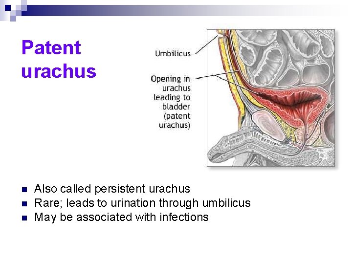 Patent urachus n n n Also called persistent urachus Rare; leads to urination through