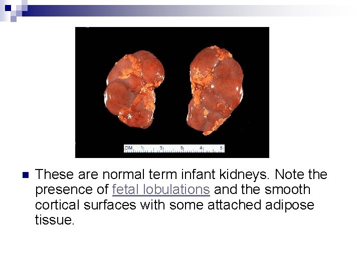 n These are normal term infant kidneys. Note the presence of fetal lobulations and