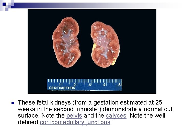 n These fetal kidneys (from a gestation estimated at 25 weeks in the second