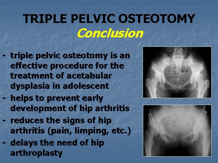 TRIPLE PELVIC OSTEOTOMY Conclusion - triple pelvic osteotomy is an effective procedure for the TRIPLE PELVIC OSTEOTOMY Conclusion - triple pelvic osteotomy is an effective procedure for the