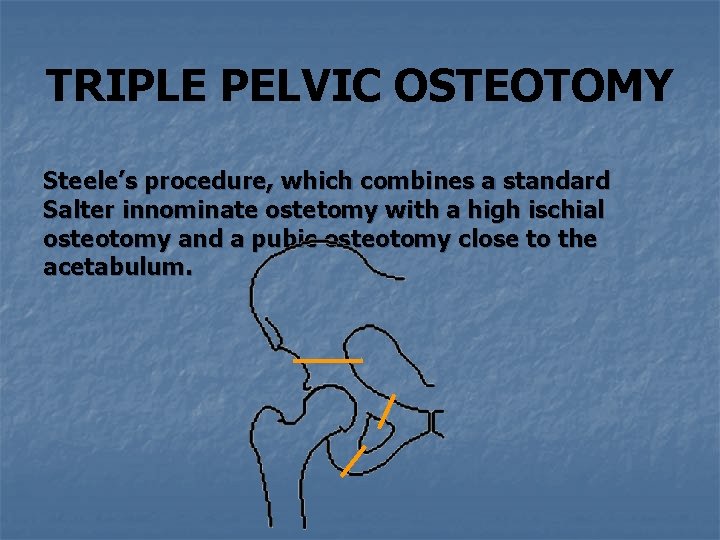 TRIPLE PELVIC OSTEOTOMY FOR THE TREATMENT OF HIP