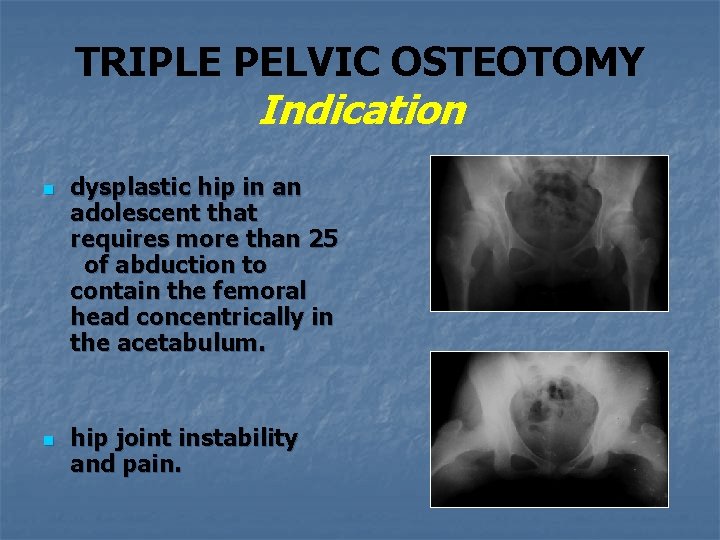 TRIPLE PELVIC OSTEOTOMY FOR THE TREATMENT OF HIP