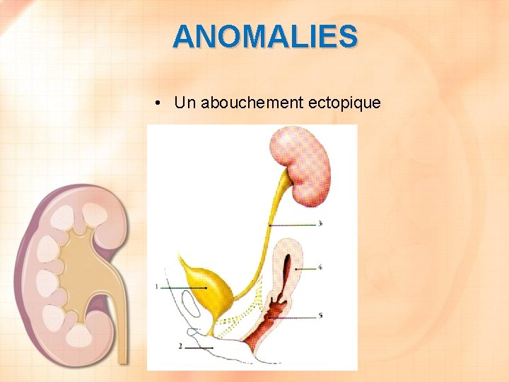 ANOMALIES • Un abouchement ectopique 