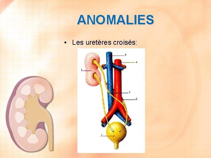 ANOMALIES • Les uretères croisés: 