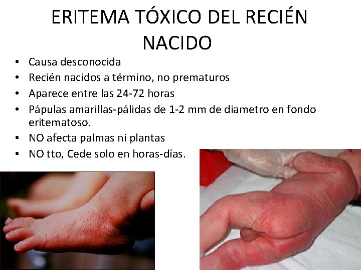 ERITEMA TÓXICO DEL RECIÉN NACIDO Causa desconocida Recién nacidos a término, no prematuros Aparece