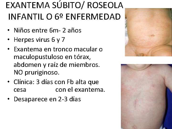 EXANTEMA SÚBITO/ ROSEOLA INFANTIL O 6º ENFERMEDAD • Niños entre 6 m- 2 años