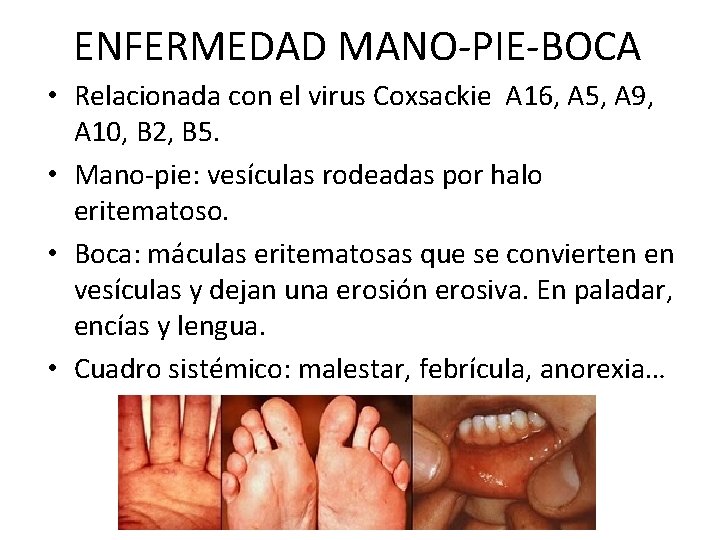 ENFERMEDAD MANO-PIE-BOCA • Relacionada con el virus Coxsackie A 16, A 5, A 9,