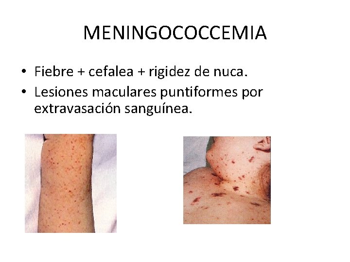 MENINGOCOCCEMIA • Fiebre + cefalea + rigidez de nuca. • Lesiones maculares puntiformes por