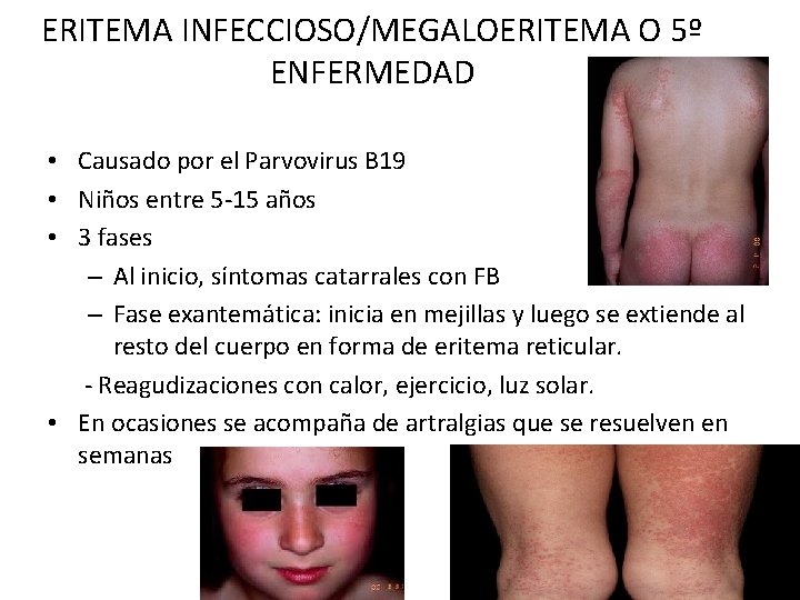 ERITEMA INFECCIOSO/MEGALOERITEMA O 5º ENFERMEDAD • Causado por el Parvovirus B 19 • Niños