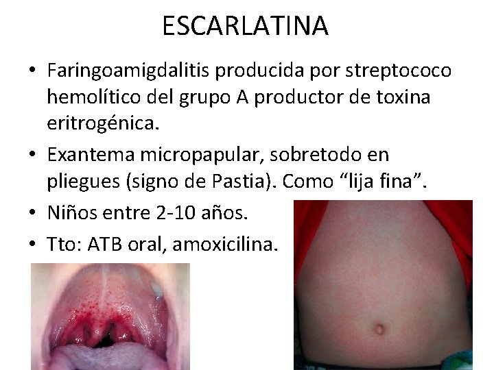 ESCARLATINA • Faringoamigdalitis producida por streptococo hemolítico del grupo A productor de toxina eritrogénica.