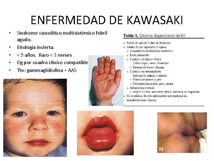 ENFERMEDAD DE KAWASAKI • • • Síndrome vasculítico multisistémico febril agudo. Etiología incierta. <