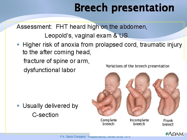 Breech presentation Assessment: FHT heard high on the abdomen, Leopold’s, vaginal exam & US. Breech presentation Assessment: FHT heard high on the abdomen, Leopold’s, vaginal exam & US.
