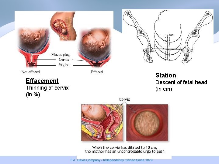Effacement Thinning of cervix (in %) Station Descent of fetal head (in cm) Effacement Thinning of cervix (in %) Station Descent of fetal head (in cm)