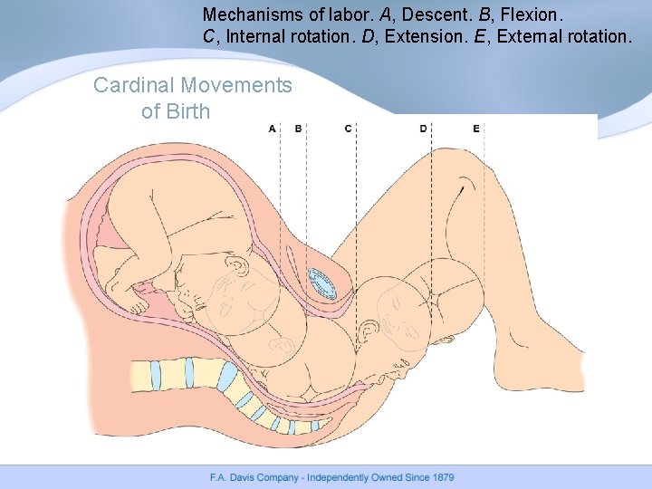 Mechanisms of labor. A, Descent. B, Flexion. C, Internal rotation. D, Extension. E, External Mechanisms of labor. A, Descent. B, Flexion. C, Internal rotation. D, Extension. E, External