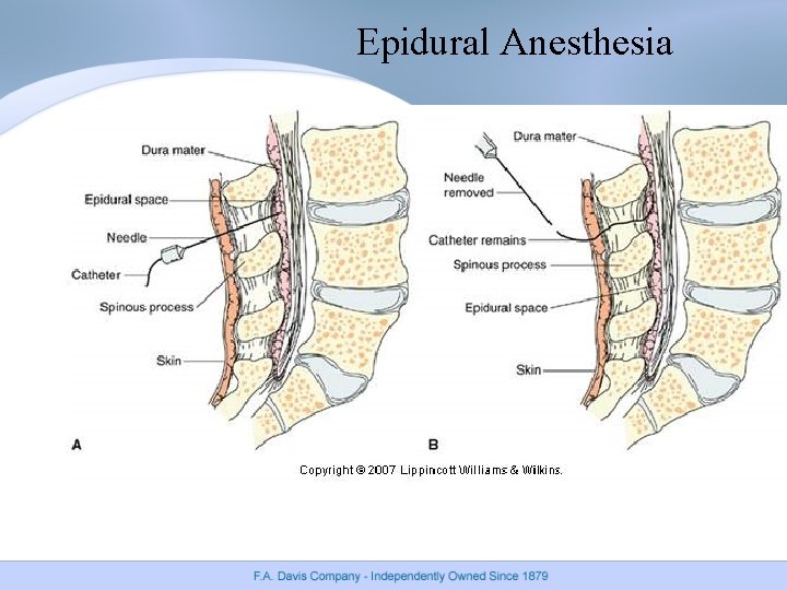 Epidural Anesthesia Epidural Anesthesia