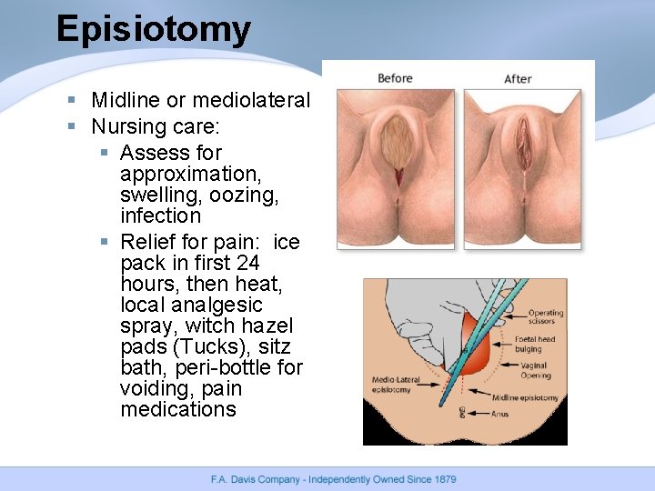 Episiotomy § Midline or mediolateral § Nursing care: § Assess for approximation, swelling, oozing, Episiotomy § Midline or mediolateral § Nursing care: § Assess for approximation, swelling, oozing,