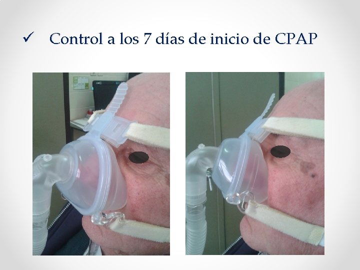 ü Control a los 7 días de inicio de CPAP 