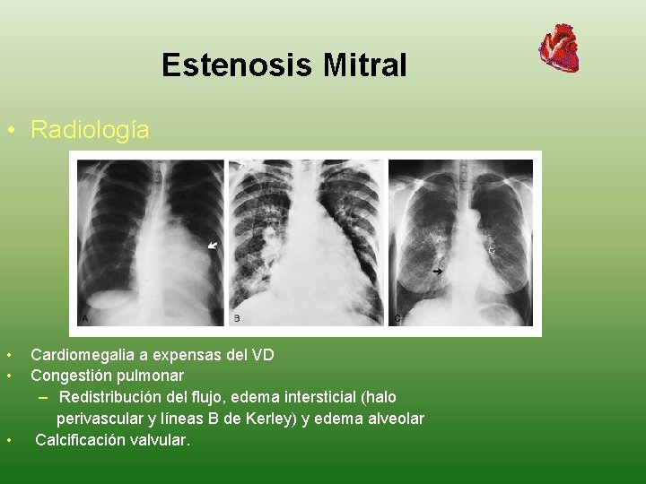 Estenosis Mitral • Radiología • • • Cardiomegalia a expensas del VD Congestión pulmonar